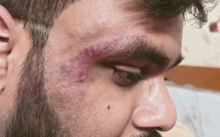 कोरबा जिले में गेवरा दीपका स्थित नेहरू शताब्दी अस्पताल (NCH) गेवरा के चिकित्सक डॉ. अर्पण विश्वास पर सोमवार को हमला किया गया