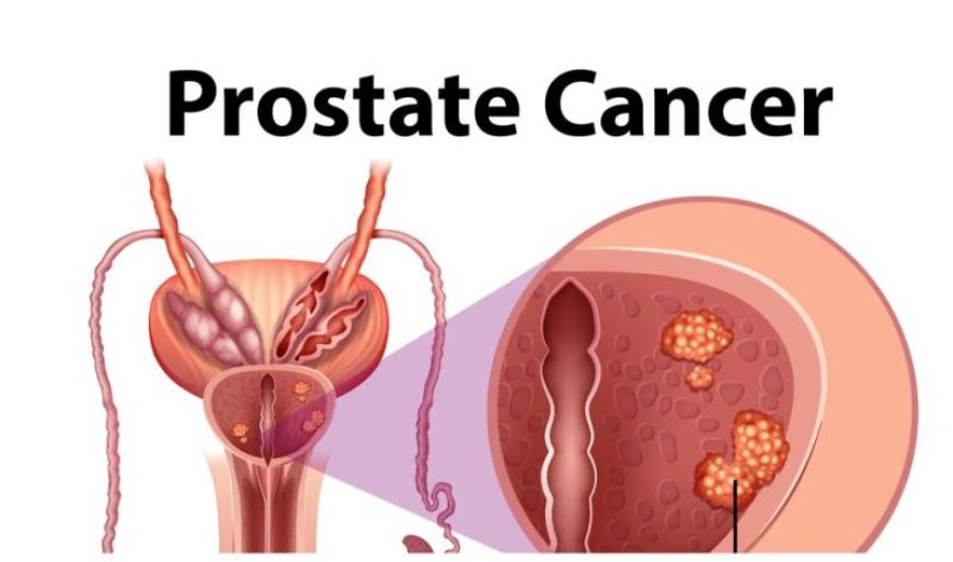 पुरुषों में बढ़ रहा प्रोस्टेट कैंसर का खतरा, जानें डॉक्टर द्वारा सुझाए गए 7 जरूरी बचाव के तरीके