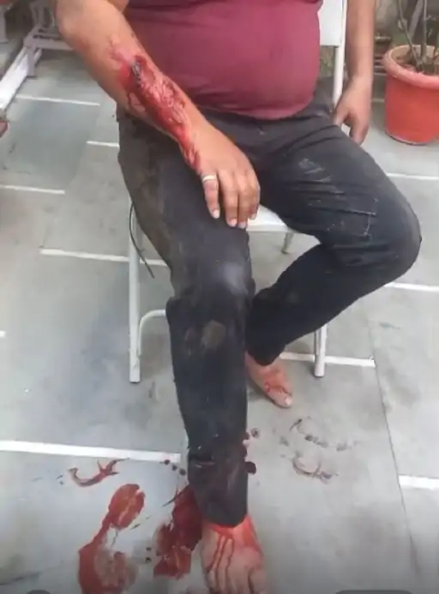 रायपुर के अनुपम नगर इलाके में पालतू कुत्ते के हमले की एक और गंभीर घटना सामने आई